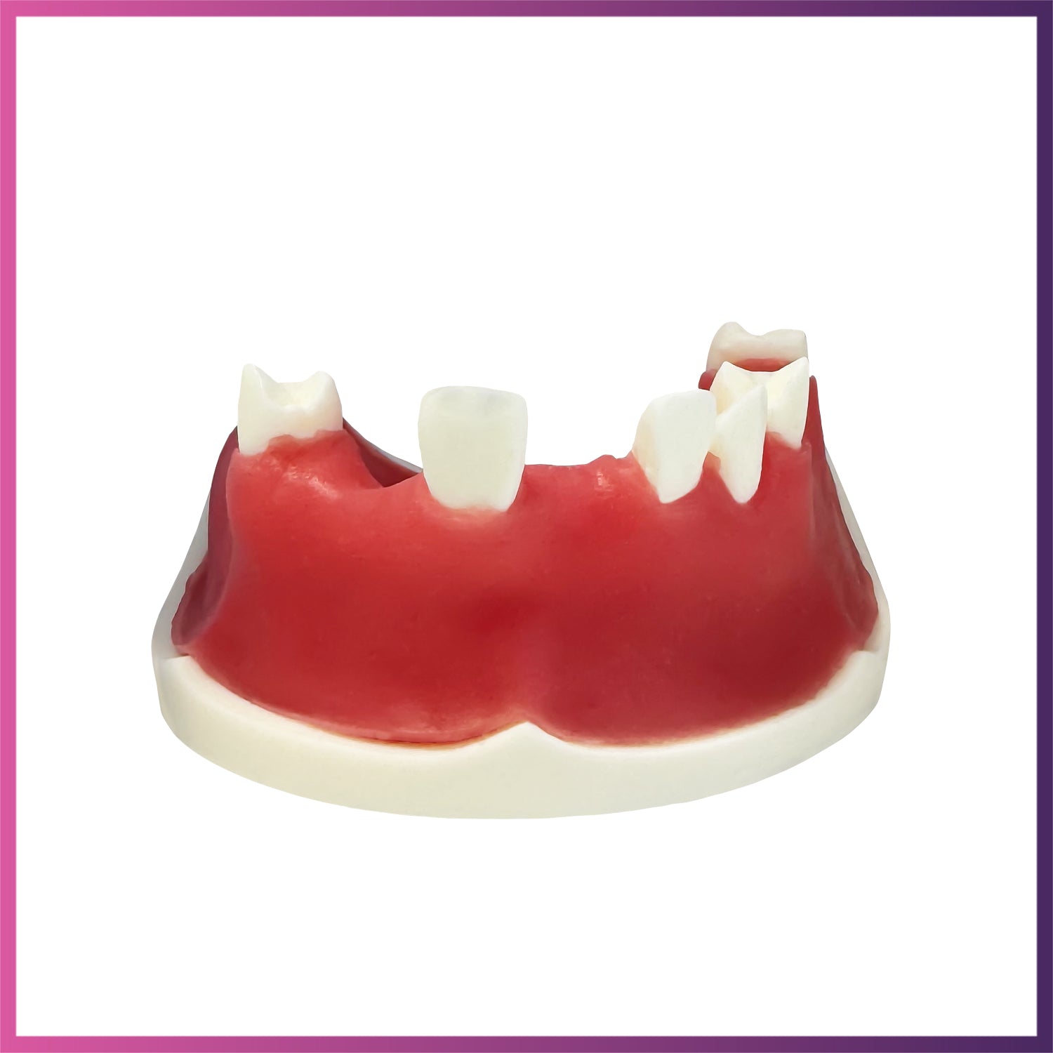 Implant Model (Lower & Upper Jaw)