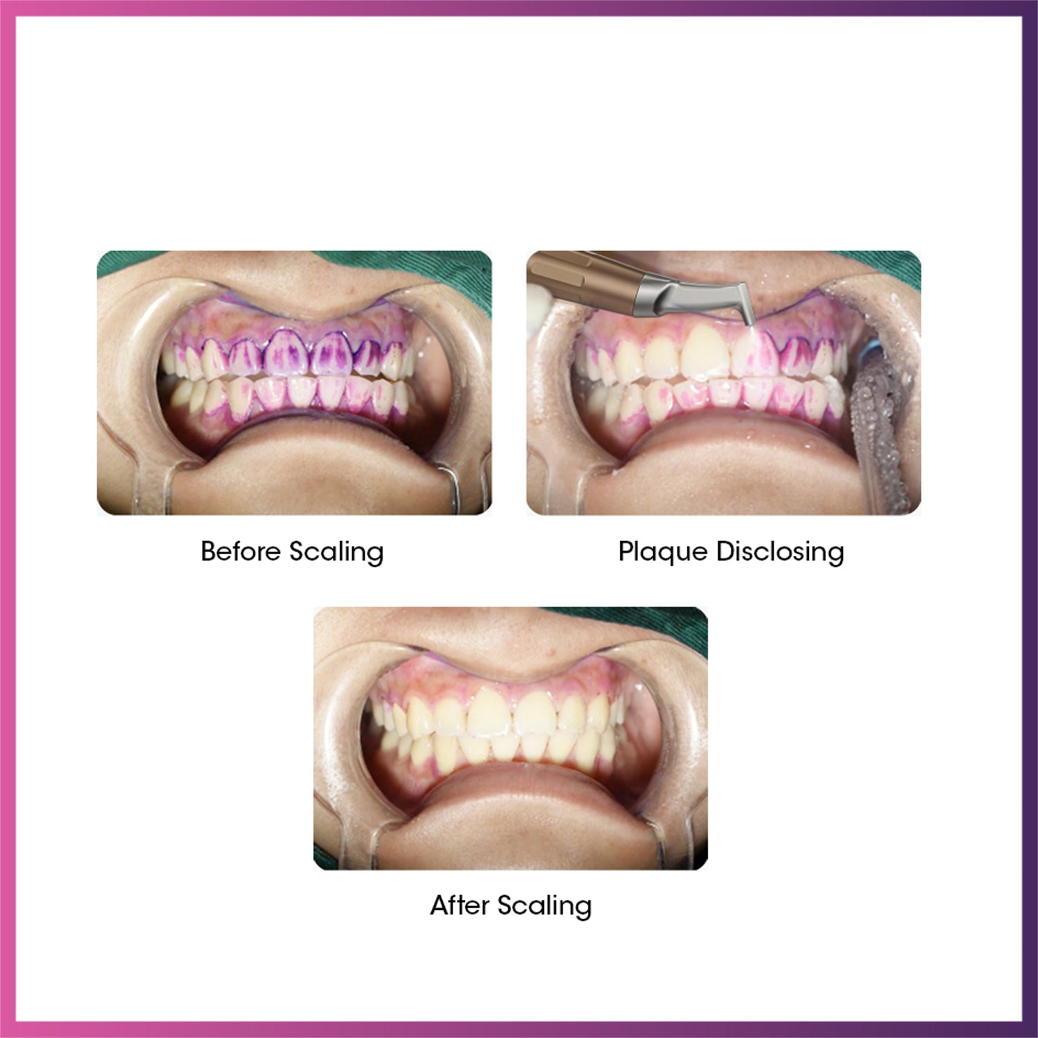 Woodpecker /  DTE Dental Air Polisher AP-A