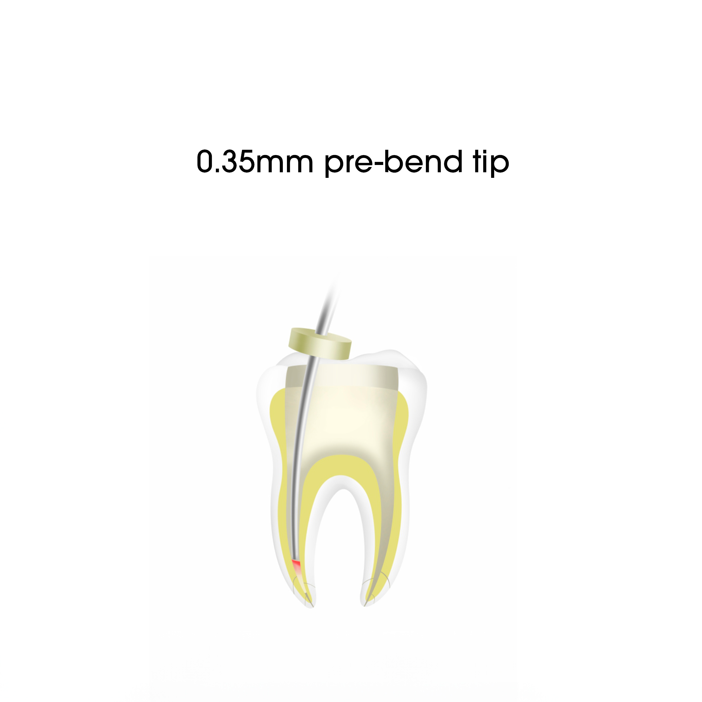 Woodpecker / DTE Gutta Percha Obturation Device ( Fi-G + Fi-P)