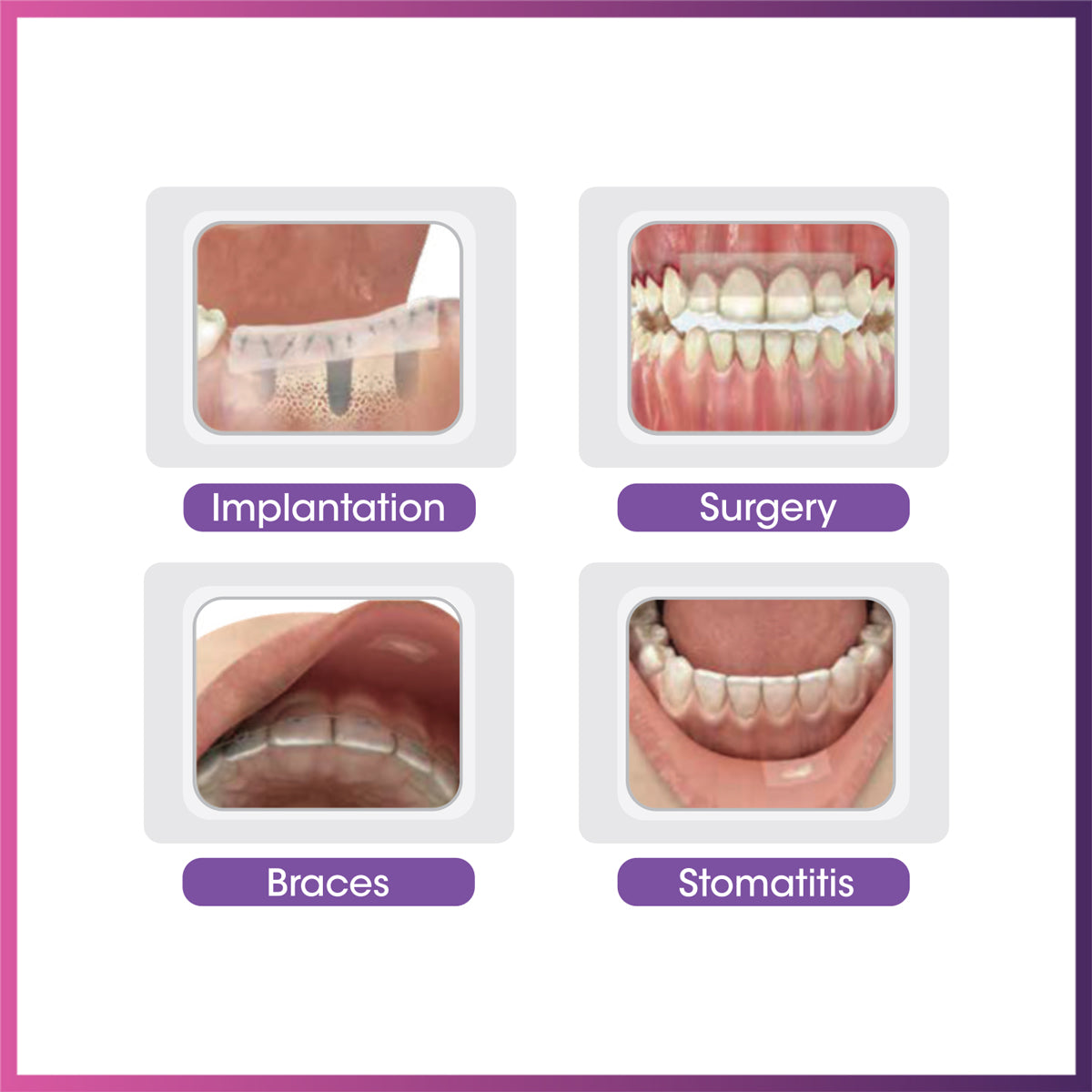 Ora-Aid - Attachable Intraoral Wound Dressing