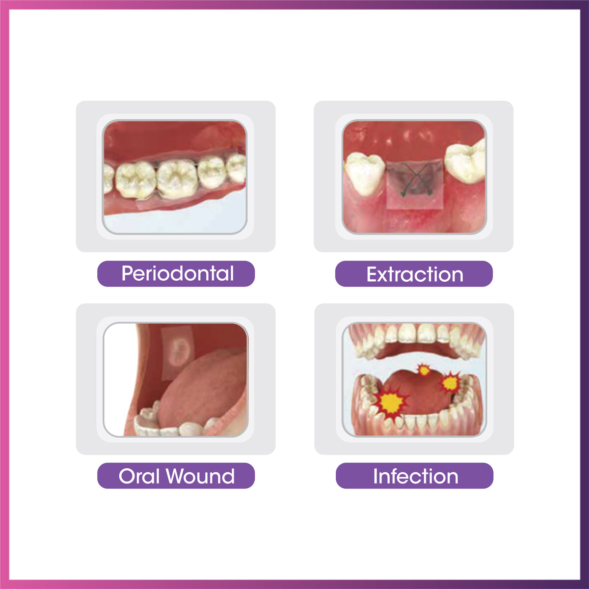 Ora-Aid - Attachable Intraoral Wound Dressing