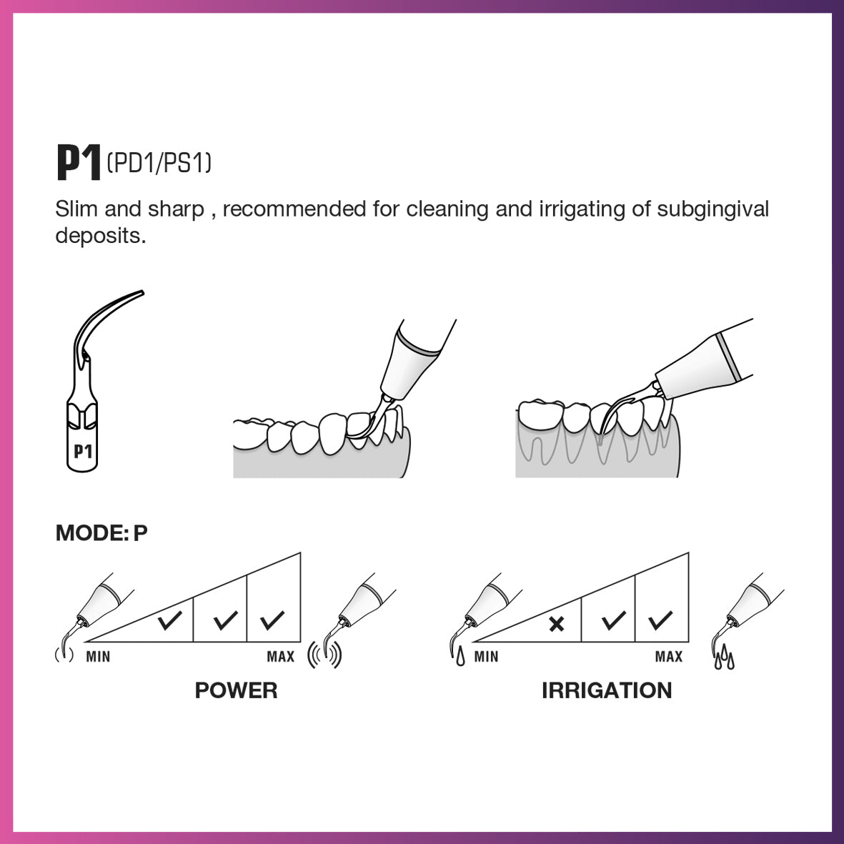 Punta periodontal Woodpecker/DTE - PD1 (paquete de 5)