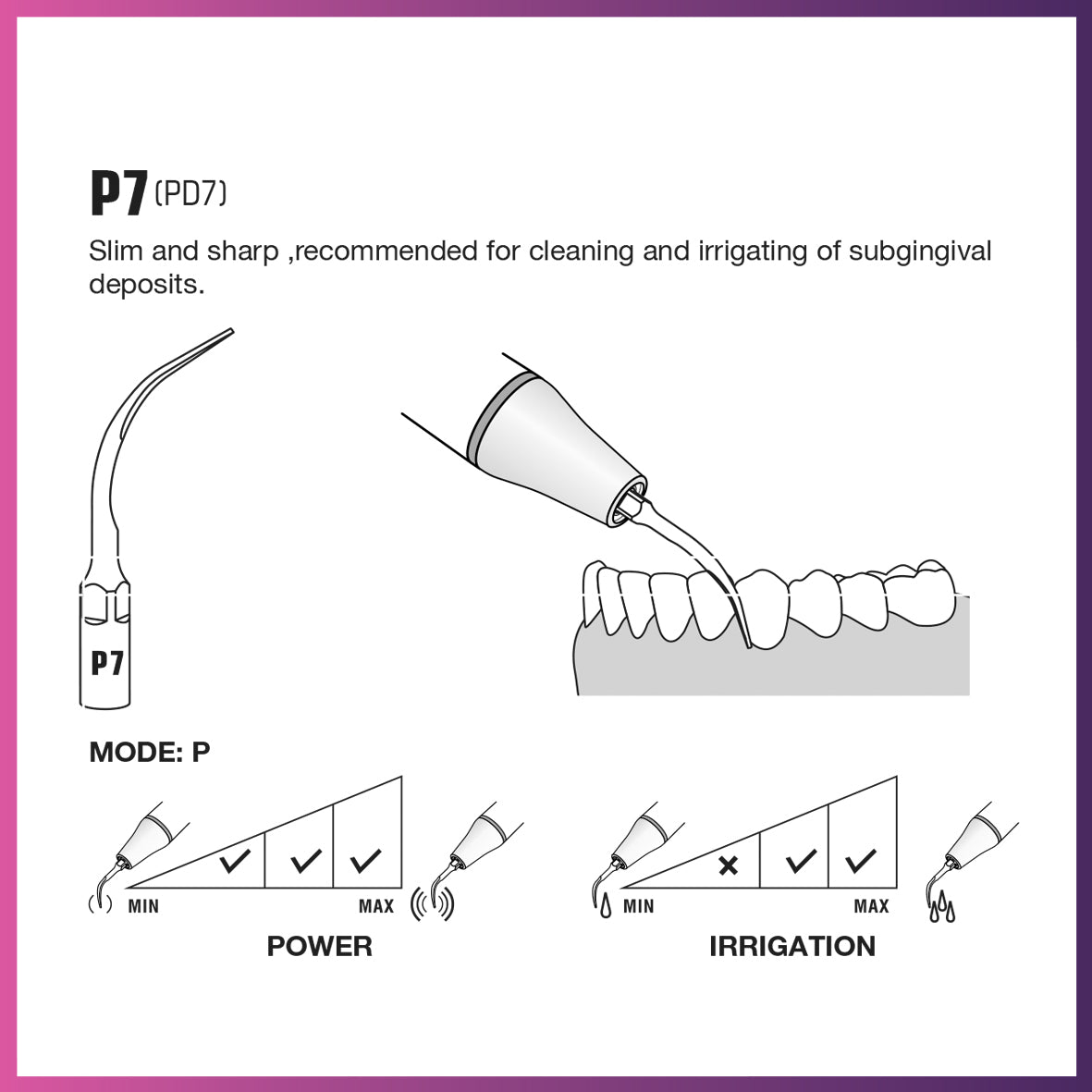 Punta periodontal Woodpecker/DTE PD7 (paquete de 5)