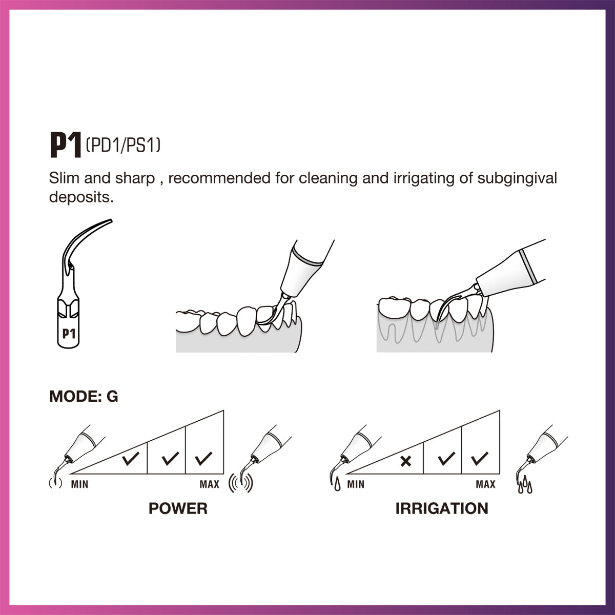 Embouts parodontaux Woodpecker / DTE - PS1 (pack de 5)