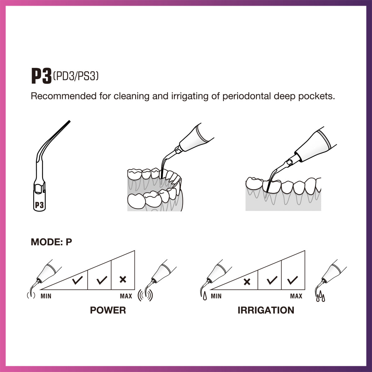 Punta periodontal Woodpecker/DTE - PD1 (paquete de 5)