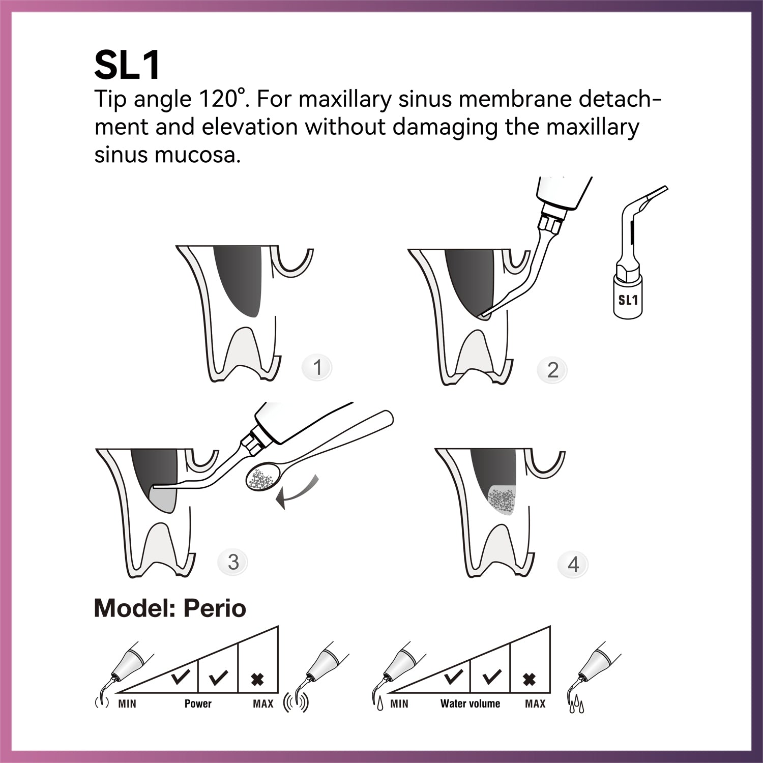 Woodpecker / DTE Surgery Tip - SL1