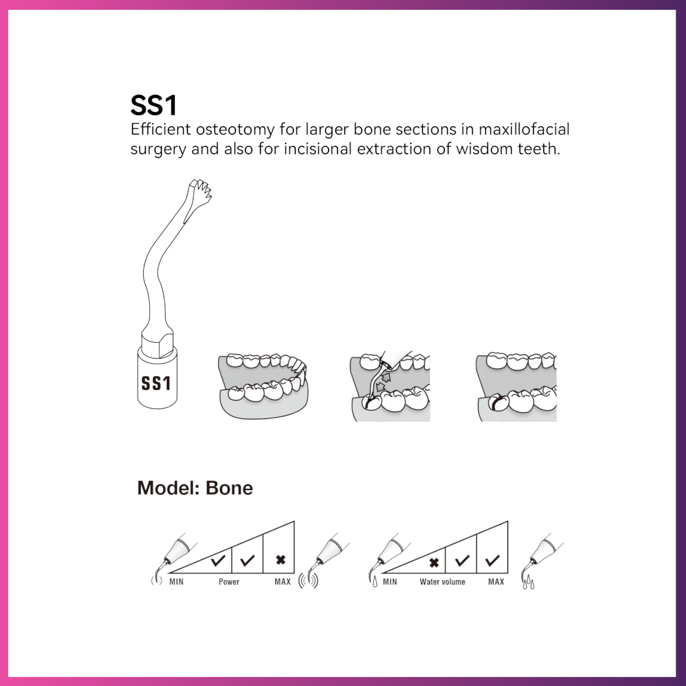 Woodpecker / DTE Surgery Tip - SS1