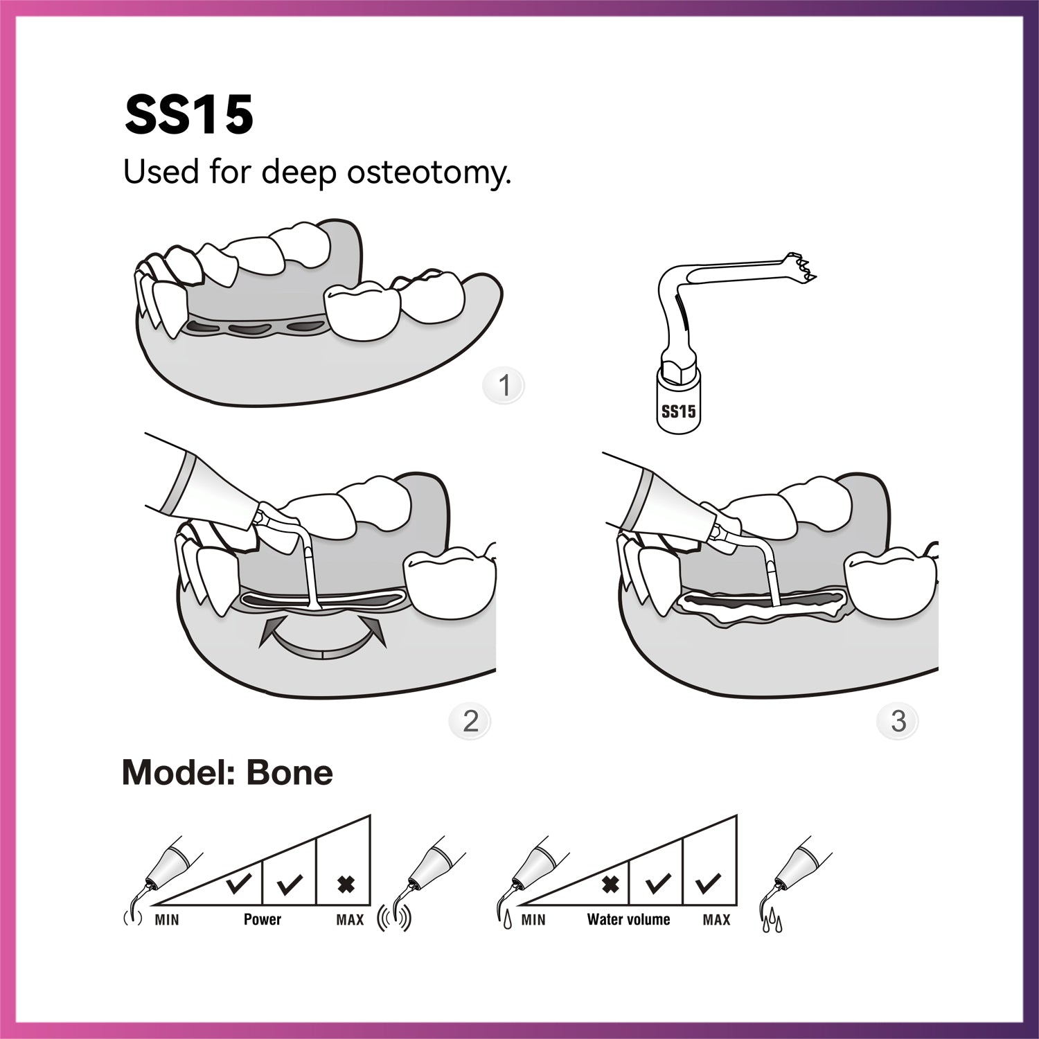 Woodpecker  Surgery Tip - SS15