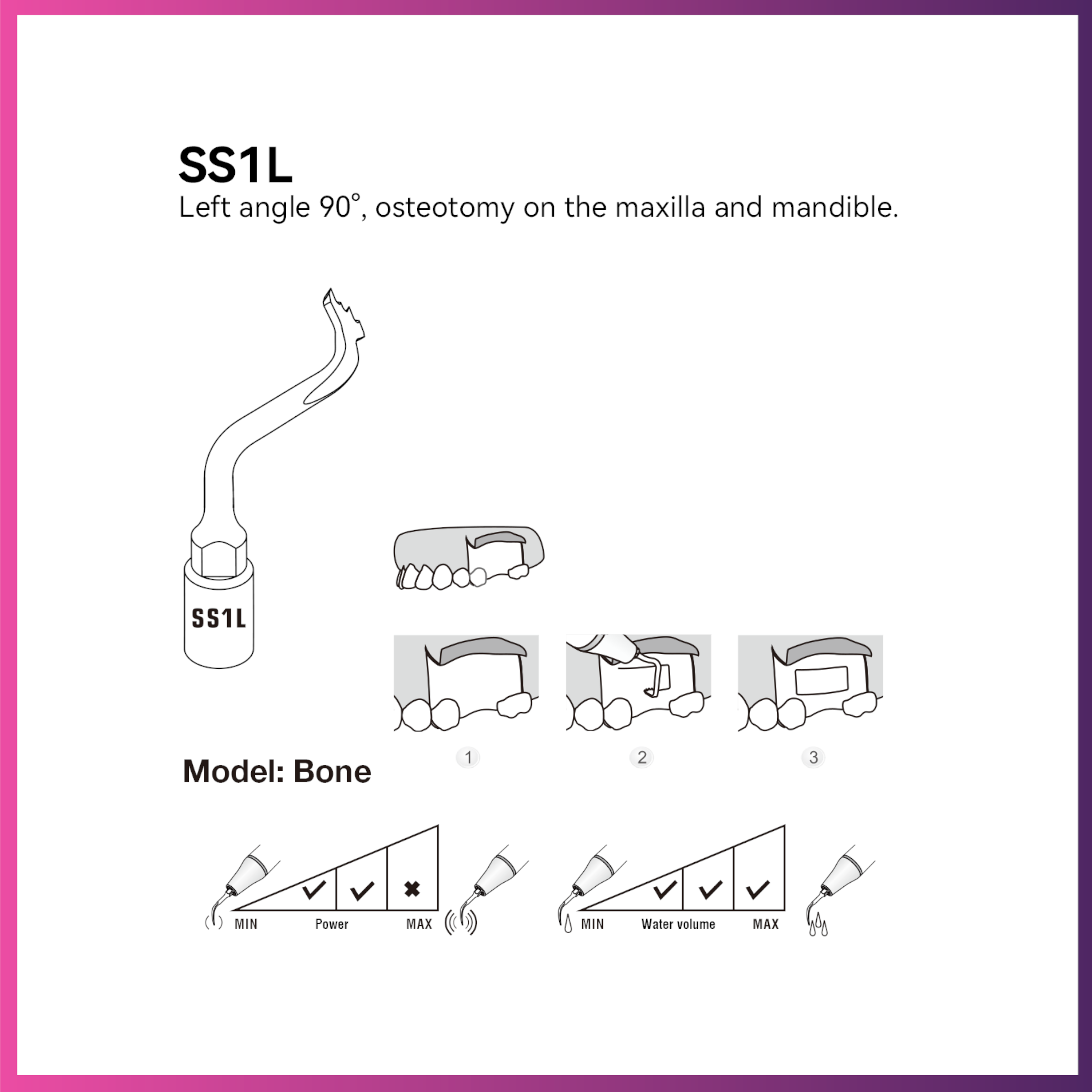 Woodpecker / DTE Surgery Tip - SS1L