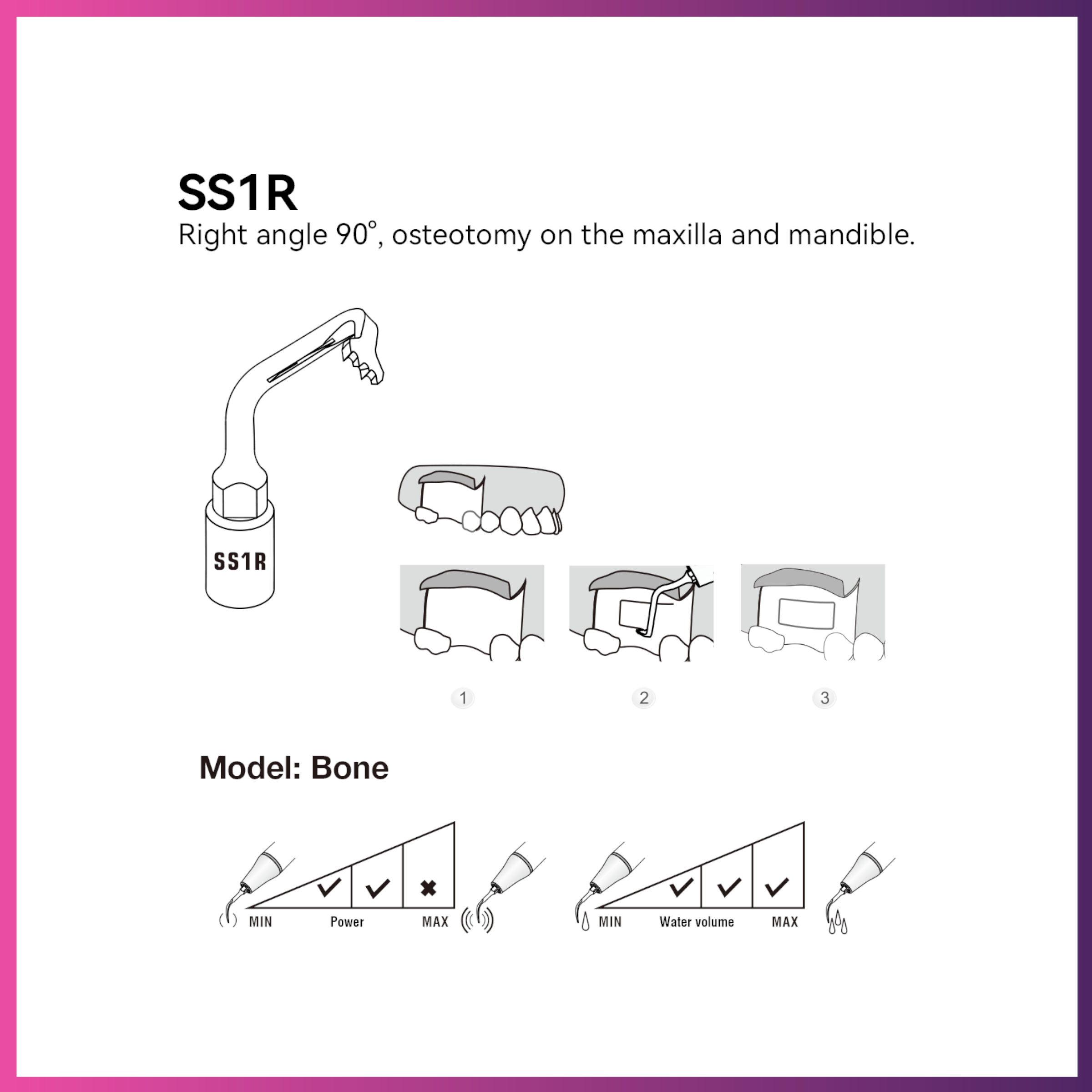 Woodpecker / DTE Surgery Tip - SS1R