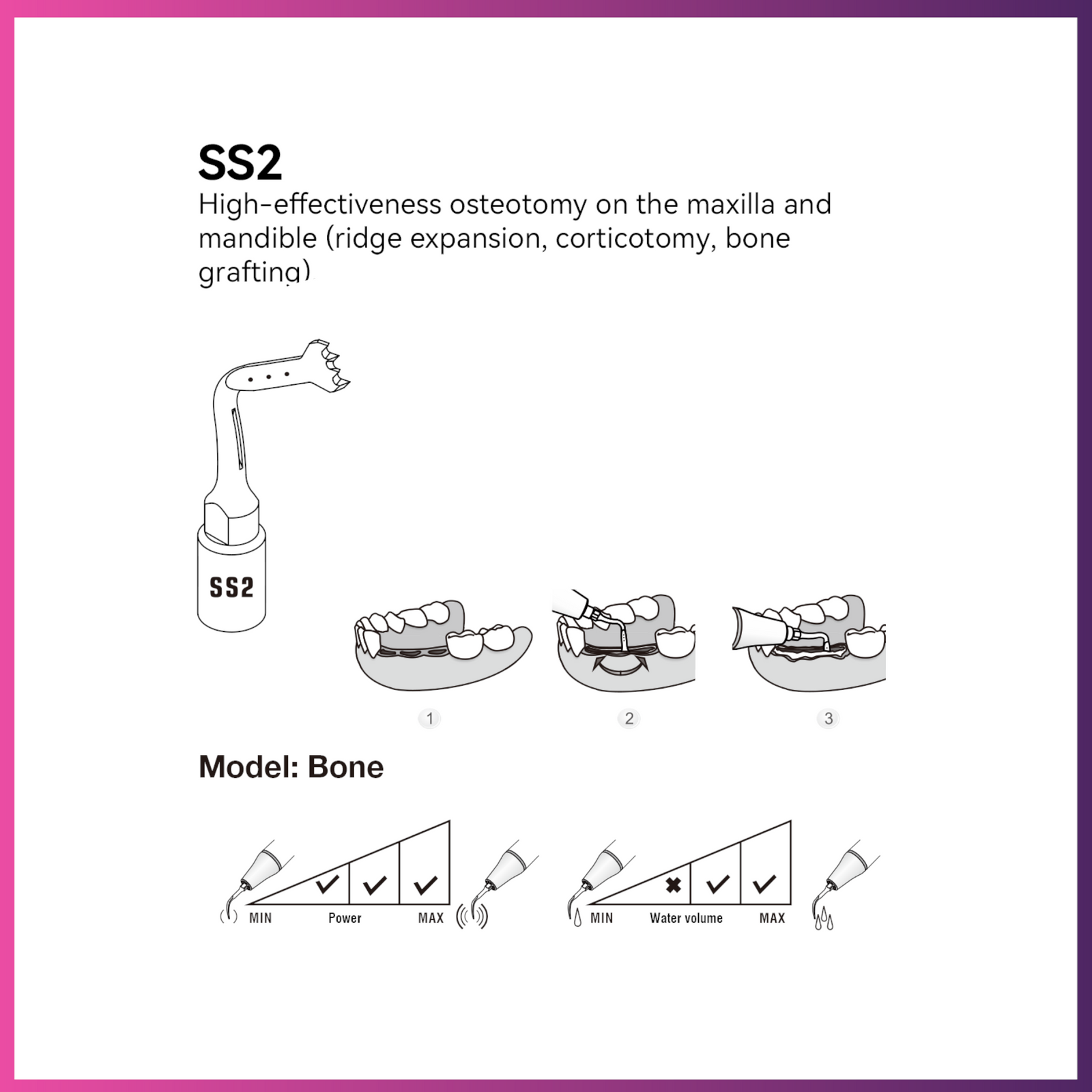 Woodpecker / DTE Surgery Tip - SS2