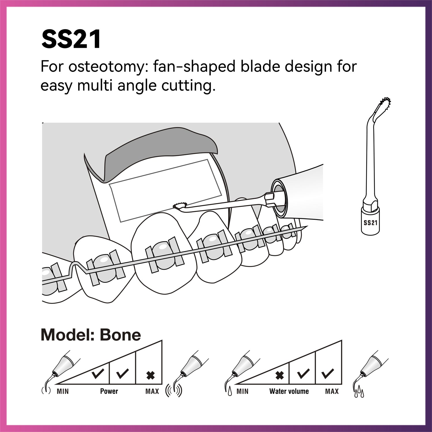 Woodpecker/ DTE Surgery Tip - SS21