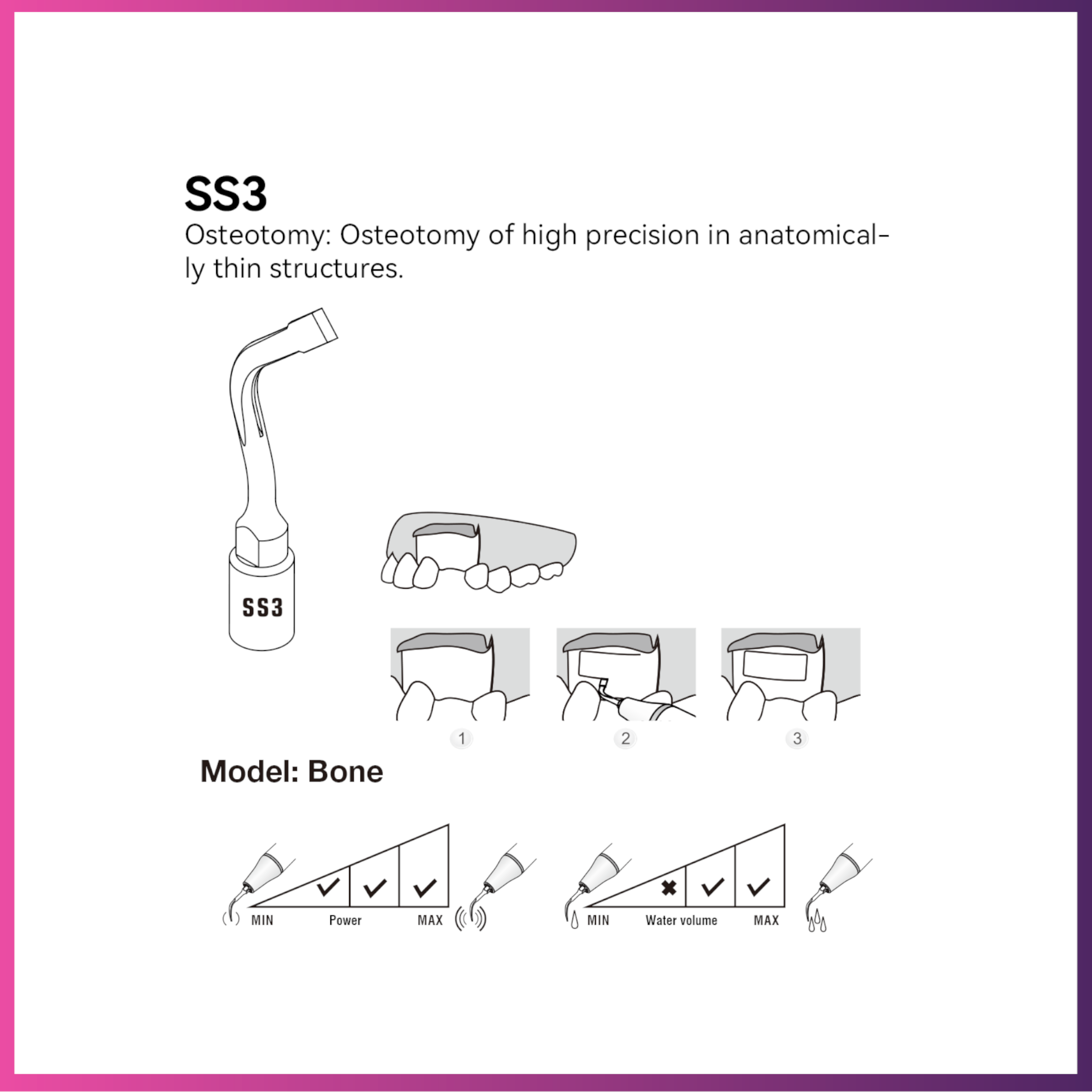 Woodpecker / DTE Surgery Tip - SS3