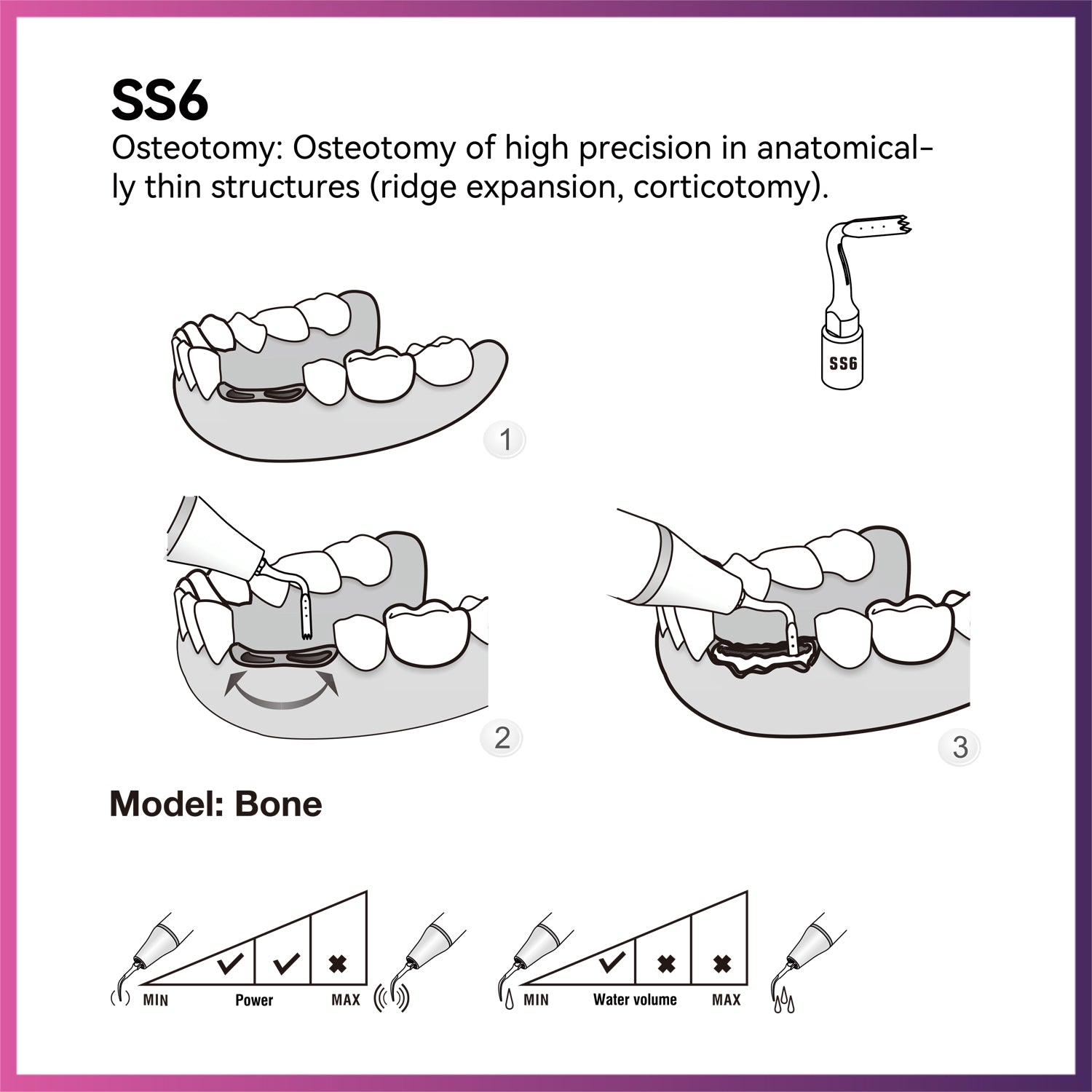 Woodpecker / DTE Surgery Tip - SS6