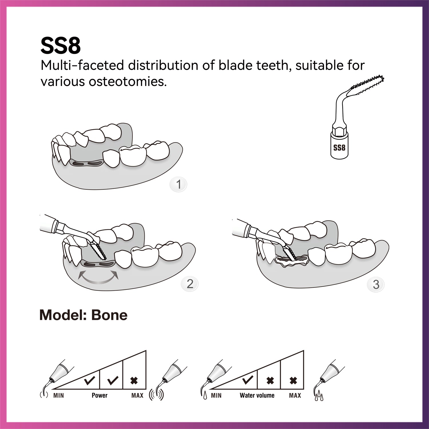 Woodpecker Surgery Tip - SS8