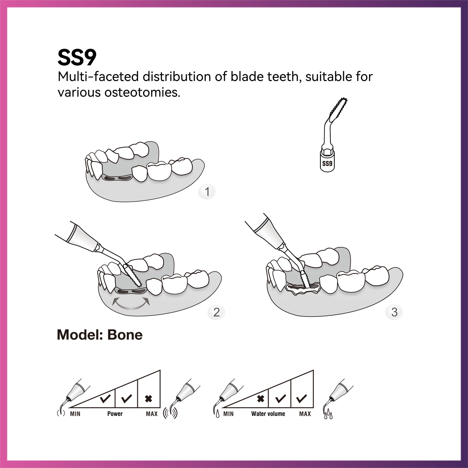 Woodpecker / DTE Surgery Tip - SS9