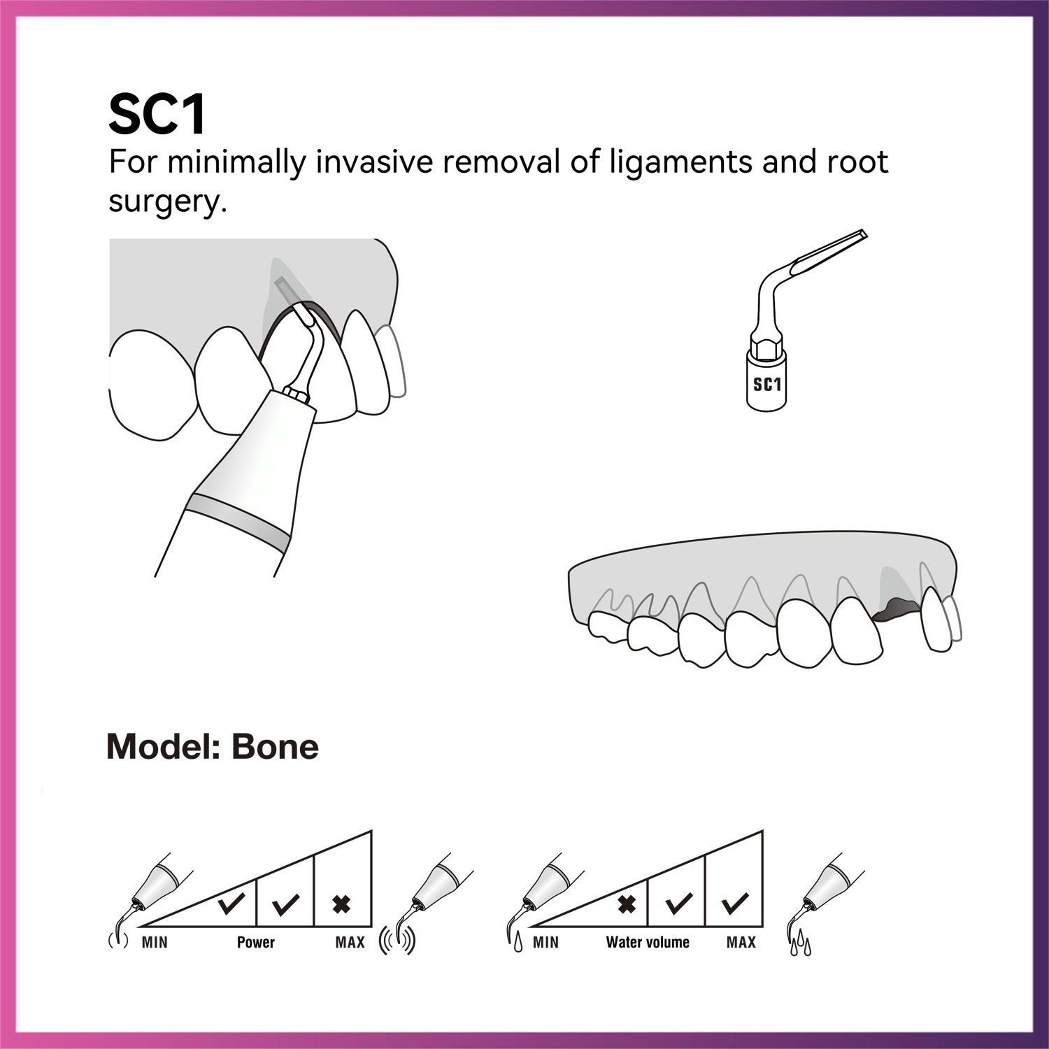 Woodpecker / DTE Surgery Tip - SC1