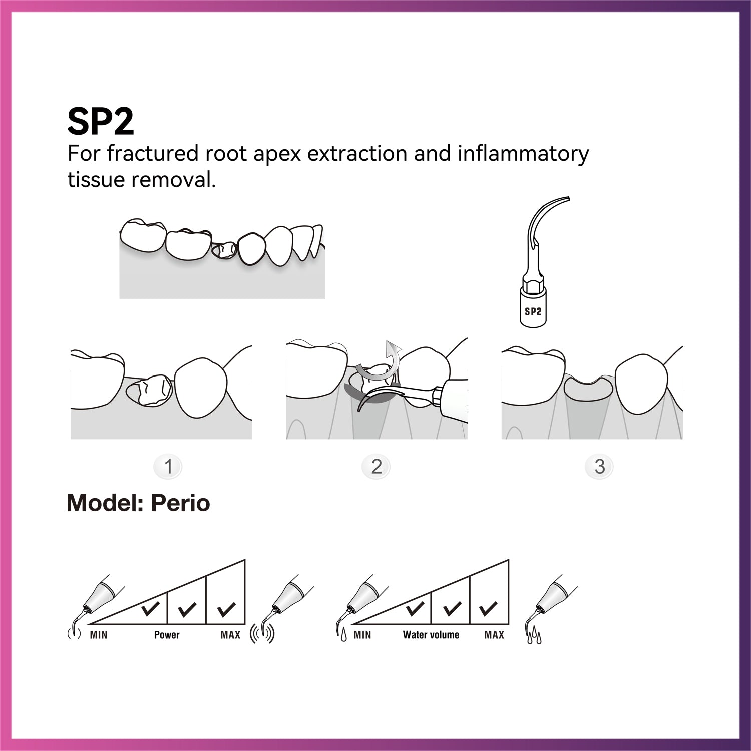 Woodpecker / DTE Surgery Tip - SP2