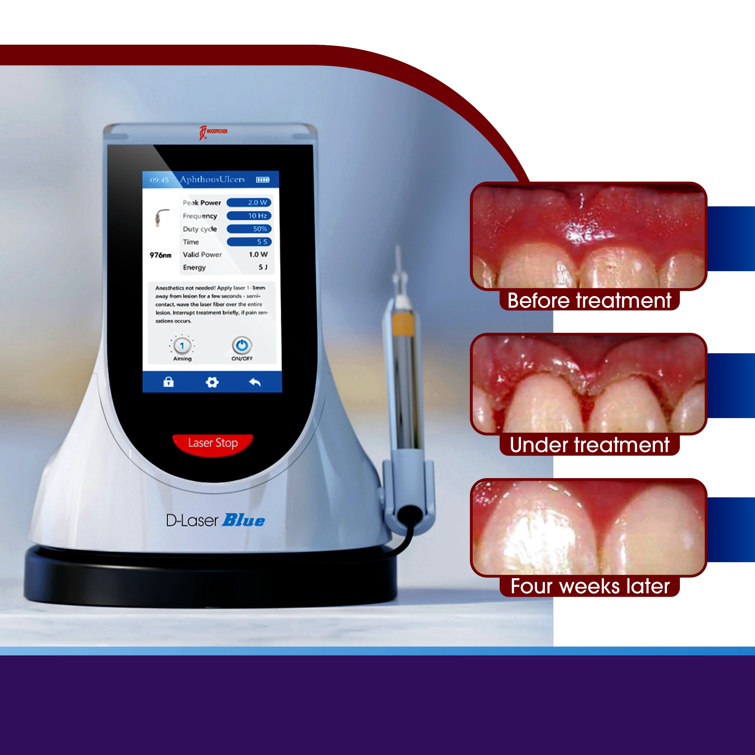 WoodPecker / DTE D-Laser Blue - Laser Therapy Device (LX16 Plus)- CALL FOR ORDER