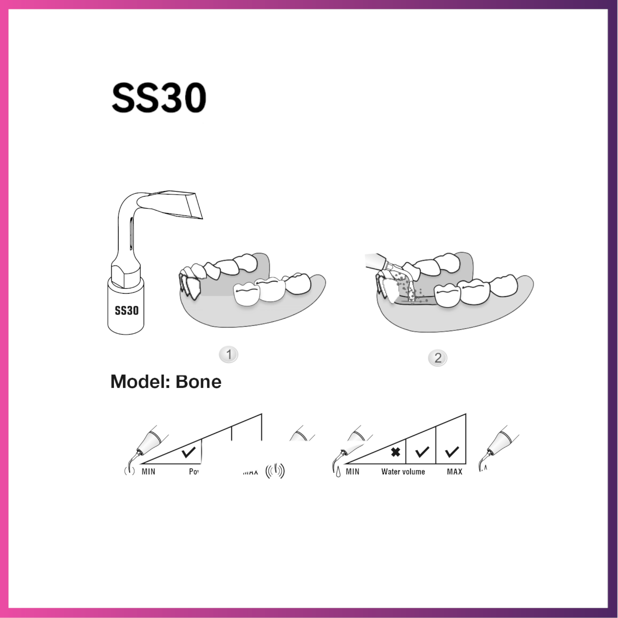 Woodpecker/ Ultra Surgery Tip - SS30