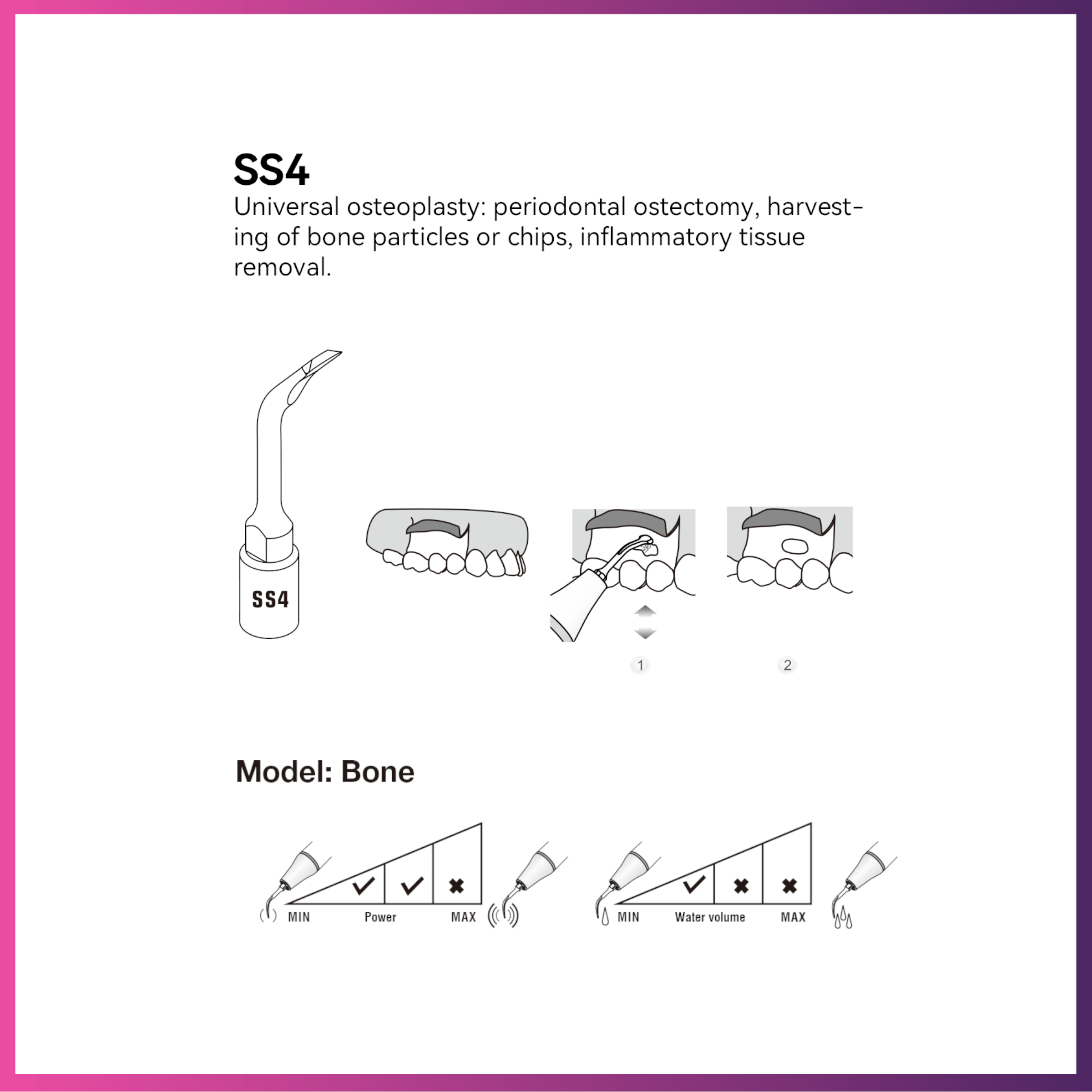 Woodpecker / DTE Surgery Tip - SS4